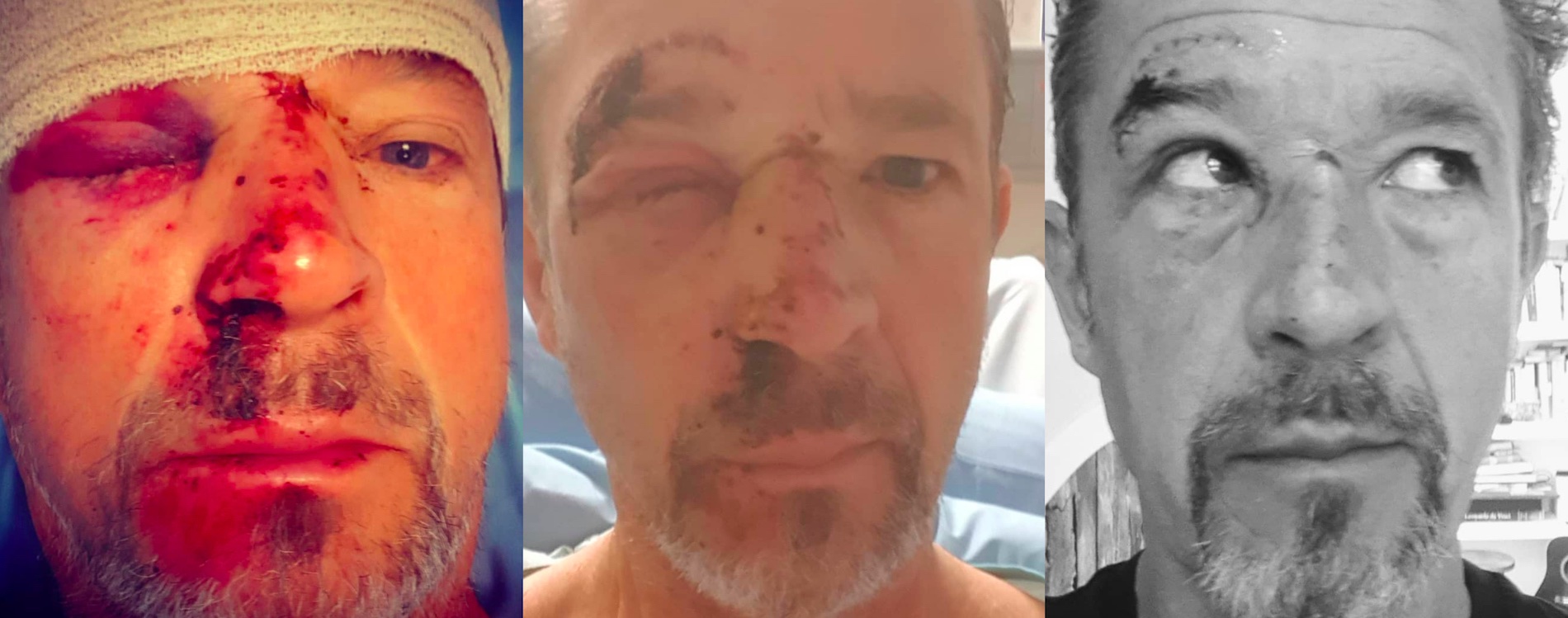 Colenso BBDO creative chairman Nick Worthington recovering from bike accident